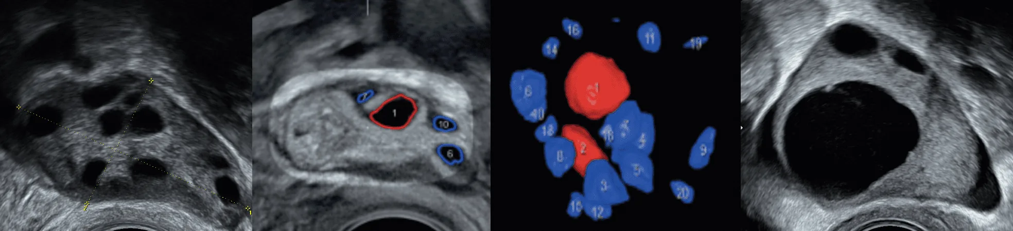 Echographie d'ovaires en écho 3D sur laquelle on peut distinguer les follicules selon leur taille par le Pr Nathalie Massin 