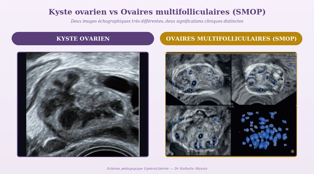 Comparaison échographique entre un kyste ovarien et des ovaires multifolliculaires SMOP en analyse 3D automatisée